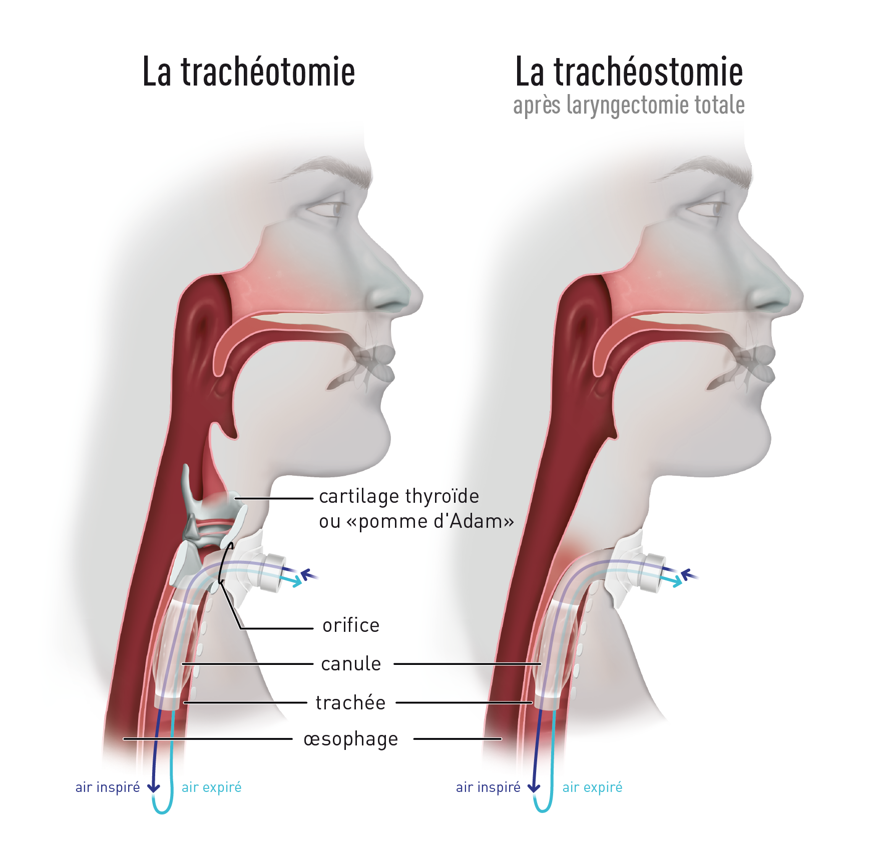 Formation mensuelle janvier 2020 La trachéotomie DOM PERFUSION