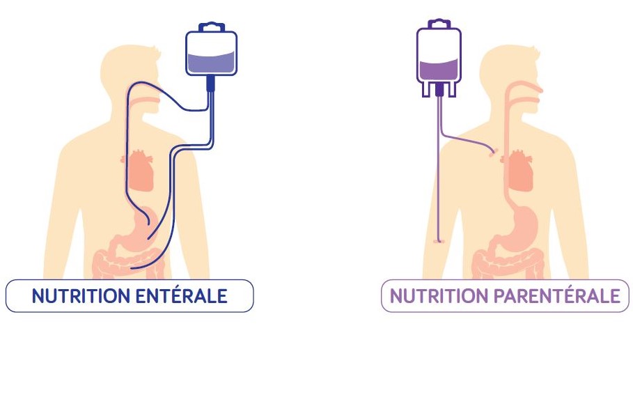 Nutrition-enterale_parenterale-2.jpg